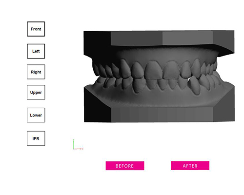 clear aligner treatment plan