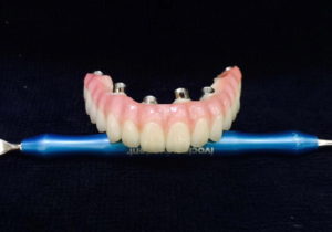 dental implant bridge