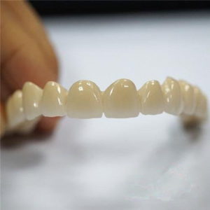 dental pfm bridge