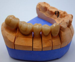 dental zirconia crown