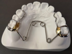 orthodontic appliance quad helix
