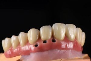 dental implant bridge