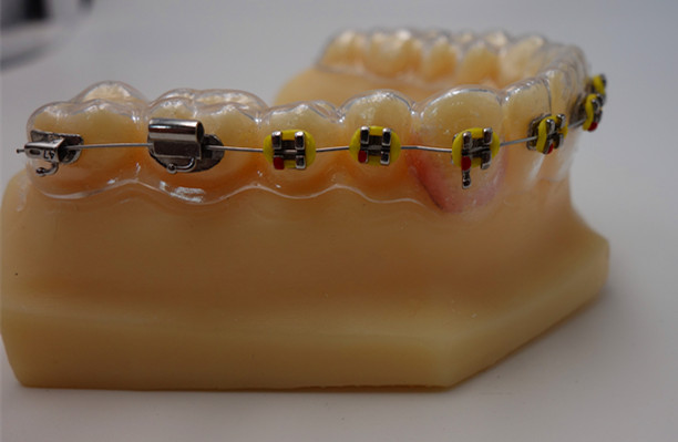 clear retainer with brackets