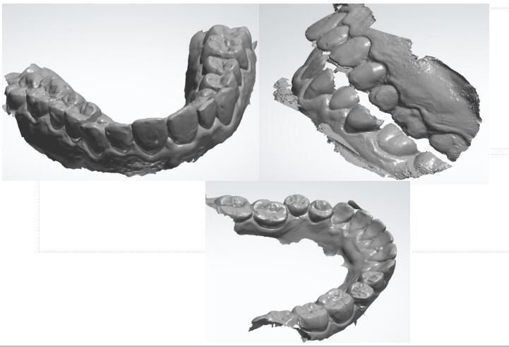 How we make Clear Aligner works? - ZHO